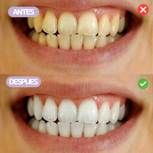 💎 Blanqueador Dental para Sonrisa Perfecta ✨